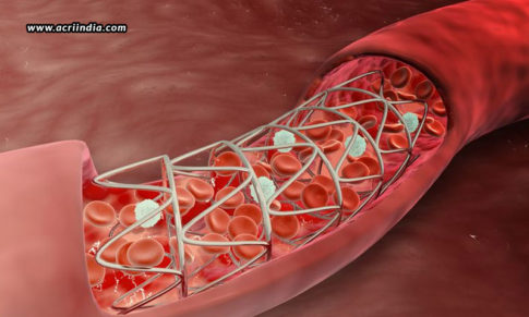 Can Restenosis Be Prevented With The New Drug-Combination?